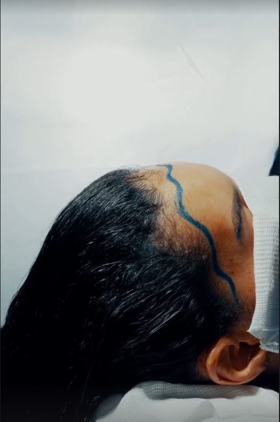 Imagem pré-operatória para documentação educacional de Long Hair FUE
