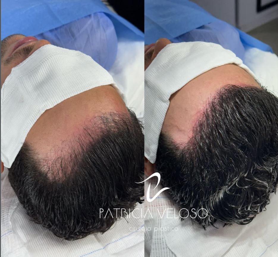 Antes e depois de procedimento Long Hair FUE conduzido pela Dra. Patricia Veloso