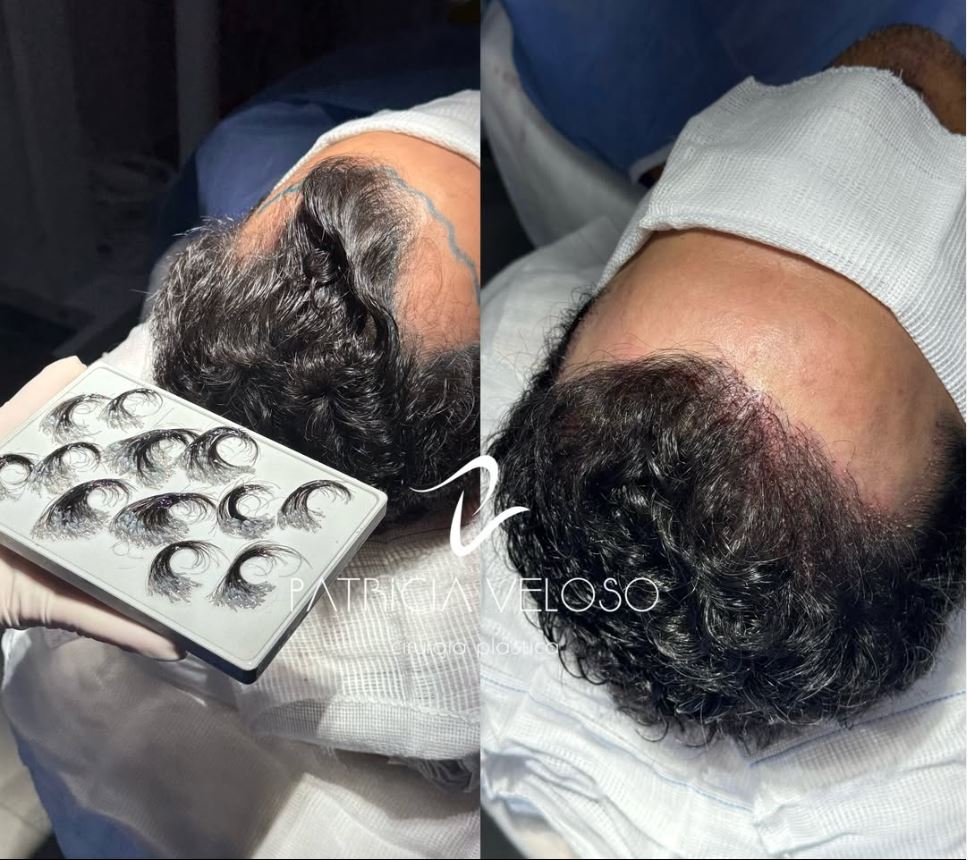 Comparativo antes e depois de transplante capilar Long Hair FUE
