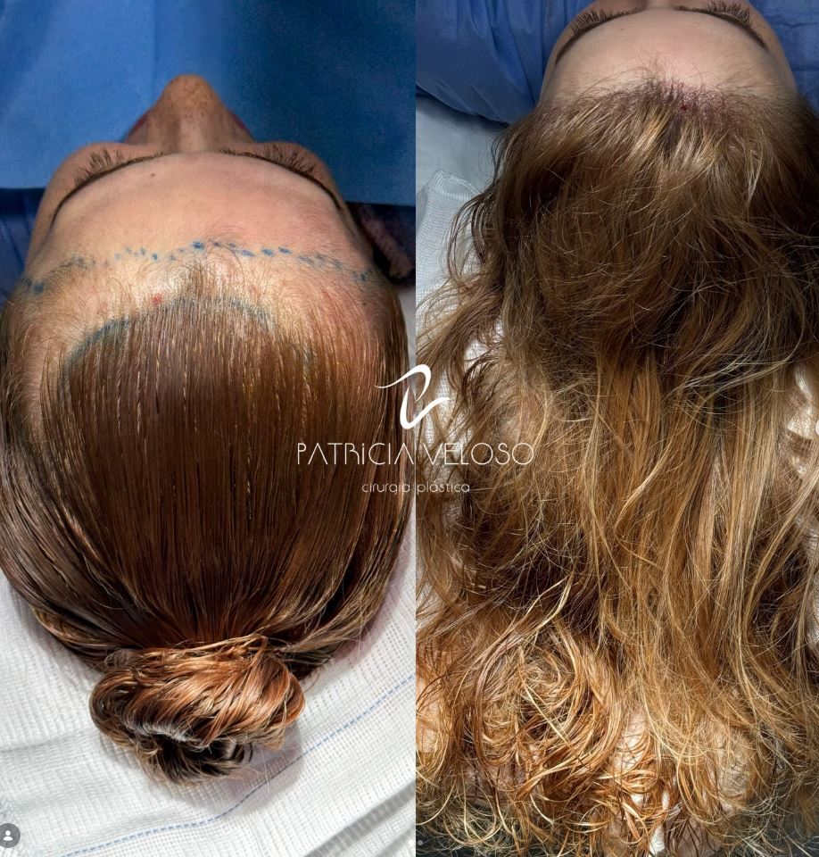 Evidência visual de caso Long Hair FUE em paciente tratado pela Dra. Patricia Veloso