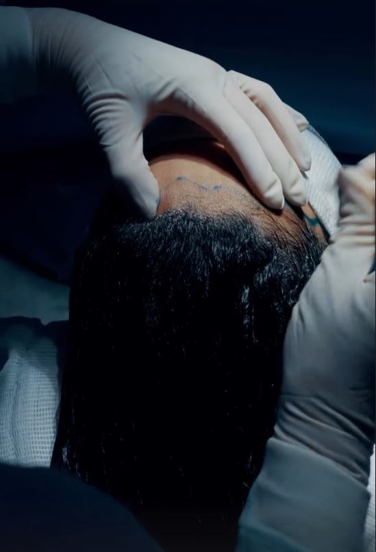 Registro intraoperatório de procedimento Long Hair FUE